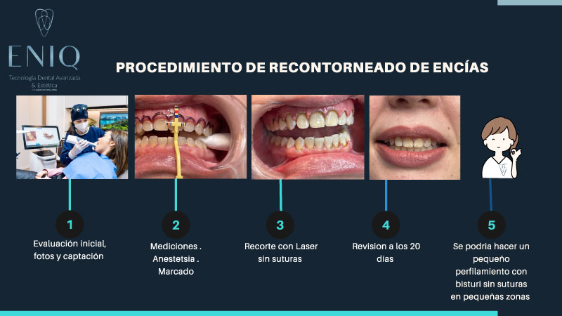 Explanation of the gum reshaping process