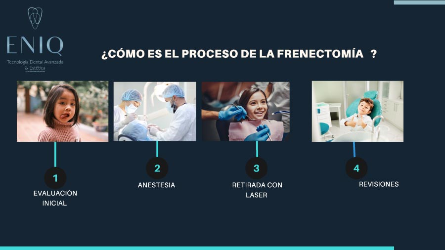 Explicación del proceso de un implante con carga inmediata