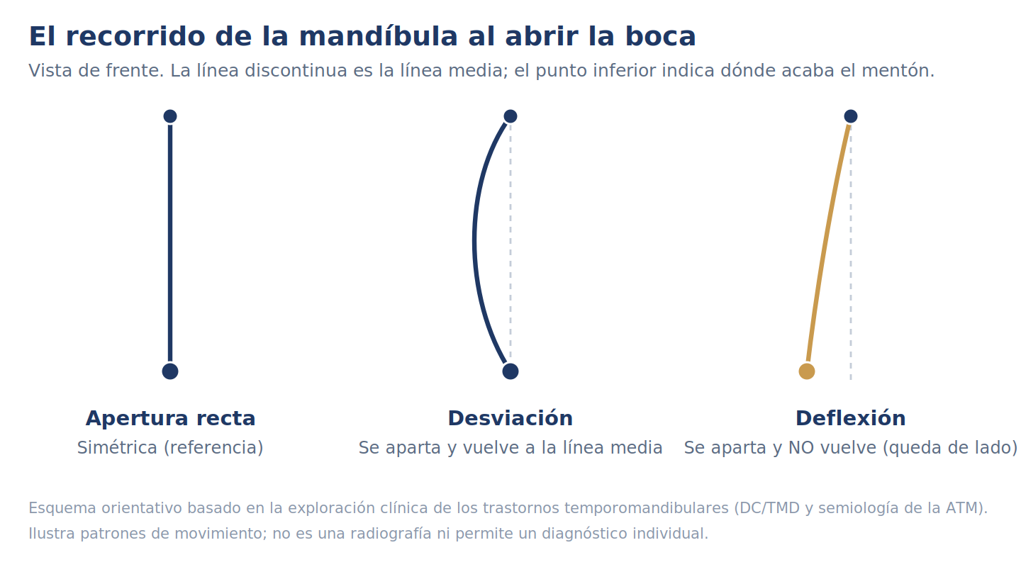 Tres patrones del recorrido de la mand&iacute;bula al abrir: recto por la l&iacute;nea media; desviaci&oacute;n que se aparta y vuelve; deflexi&oacute;n que se aparta y no vuelve.